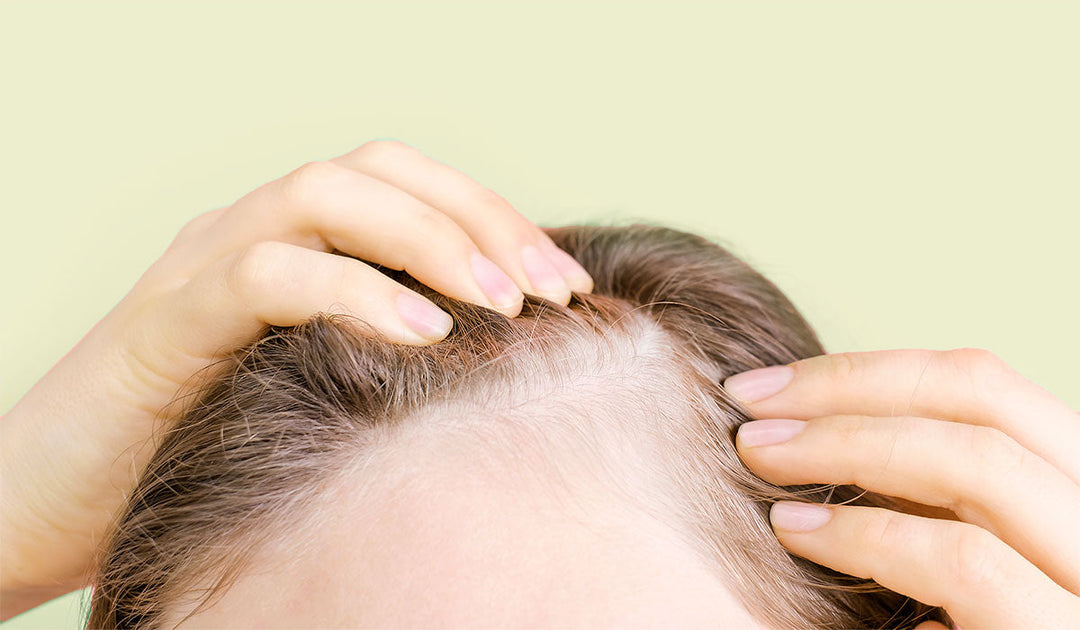 Haarausfall bei Hashimoto: So rettest Du Dein Haar